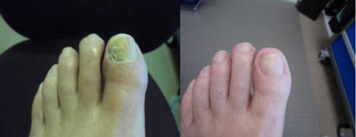 Снимки на краката преди и след използване на крем Zenidol