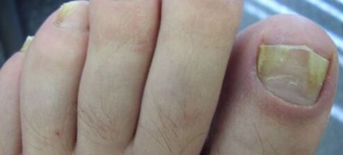 симптоми на гъбички по ноктите и лечението им с оцет