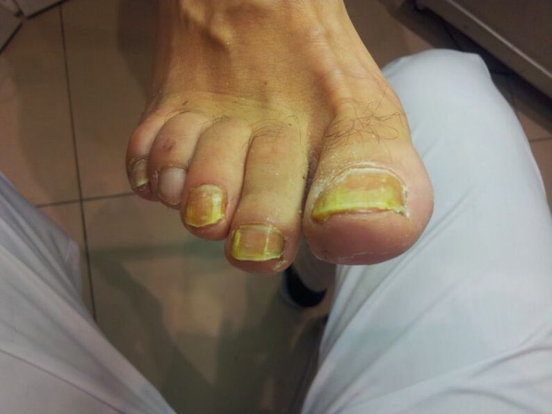 жълти нокти на краката с гъбички