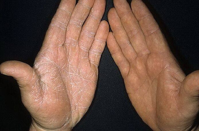 симптоми на гъбички по кожата на ръцете