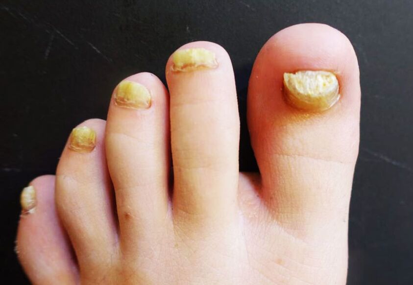 Неестетичен вид на ноктите на краката, засегнати от гъбички