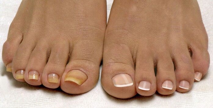 Гъбички на ноктите на ноктите на единия крак