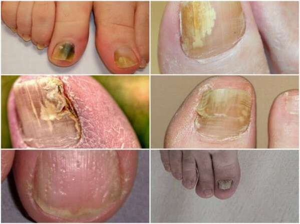 признаци на гъбички по ноктите на краката