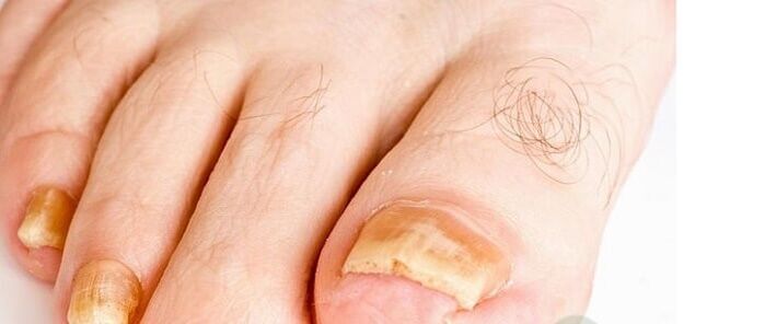сортове гъбички на ноктите на краката