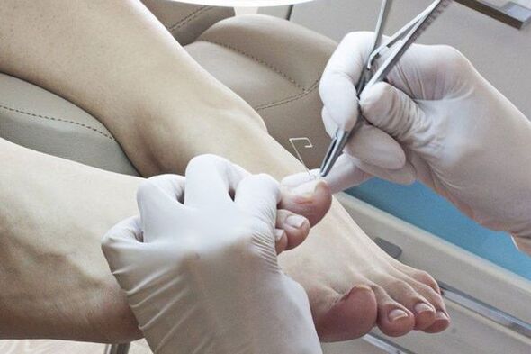 Механично отстраняване на ноктите на краката, засегнати от гъбички