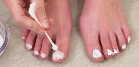 лечение на гъбички по ноктите на краката с мехлем