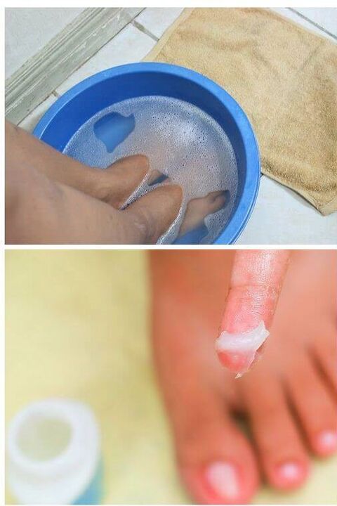 използването на естествени масла при лечението на гъбички по ноктите на краката