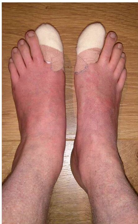 премахване на ноктите на краката, засегнати от гъбички