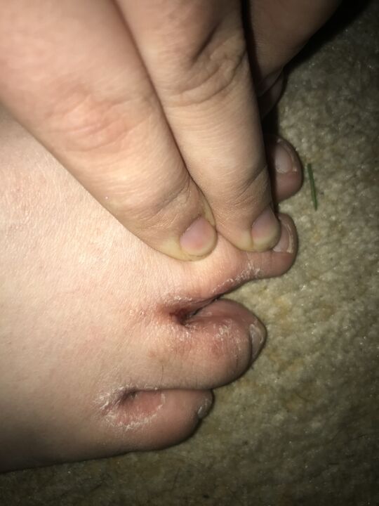 гъбична инфекция на пръстите на краката