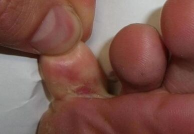 пукнатина в пръста на крака е резултат от гъбична инфекция