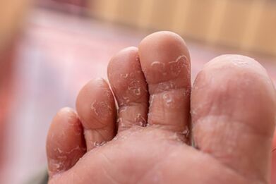 симптоми на гъбични инфекции на пръстите на краката